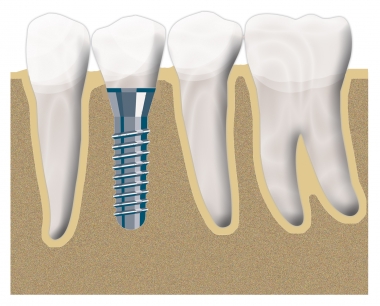 Implantat Position