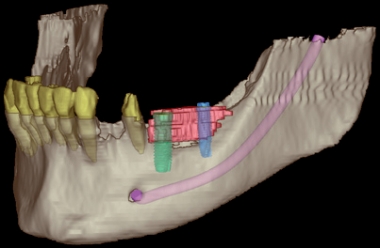 Diditale Implantatplanung