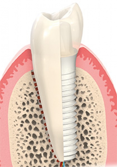 Keramikimplantat